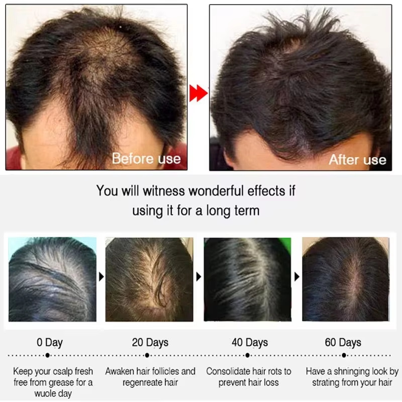 速効性ジンジャーヘアグローススプレー、毛根育成、脱毛防止、育 - Hair Care Growth のレビューと価格